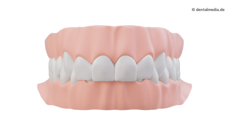 Zahnfehlstellung tiefer Biss