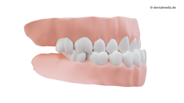 Zahnfehlstellung Vorbiss